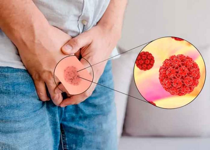 1 El virus del papiloma humano puede causar cáncer en los hombres.