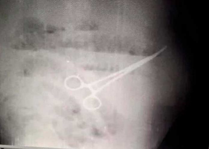 1 Le practican cirugía y le dejan las tijeras en el estómago