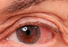 ¿Cómo podemos prevenir el glaucoma?, ¡Aquí te contamos!