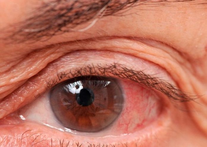 ¿Cómo podemos prevenir el glaucoma?, ¡Aquí te contamos!