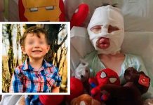 Niño es quemado intencionalmente por otro mientras jugaban en Estados Unidos Niño es quemado intencionalmente por otro mientras jugaban en Estados Unidos