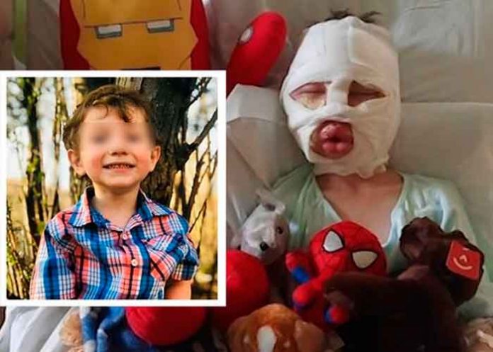 Niño es quemado intencionalmente por otro mientras jugaban en Estados Unidos