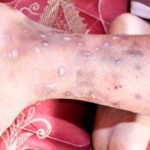 ¡Alerta sanitaria! Detectan una rara y contagiosa enfermedad en Haití