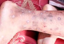 ¡Alerta sanitaria! Detectan una rara y contagiosa enfermedad en Haití ¡Alerta sanitaria! Detectan una rara y contagiosa enfermedad en Haití