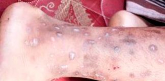 ¡Alerta sanitaria! Detectan una rara y contagiosa enfermedad en Haití