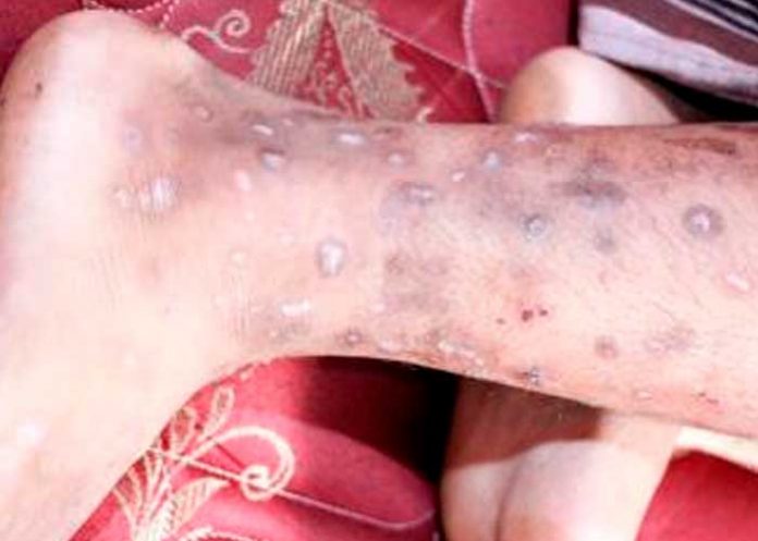 ¡Alerta sanitaria! Detectan una rara y contagiosa enfermedad en Haití