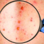 ¡Alerta! Según la OMS aumentan los casos de sarampión en el mundo