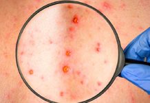 ¡Alerta! Según la OMS aumentan los casos de sarampión en el mundo ¡Alerta! Según la OMS aumentan los casos de sarampión en el mundo