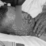 Se confirma en Estados Unidos primer caso de viruela de los monos en 2022.