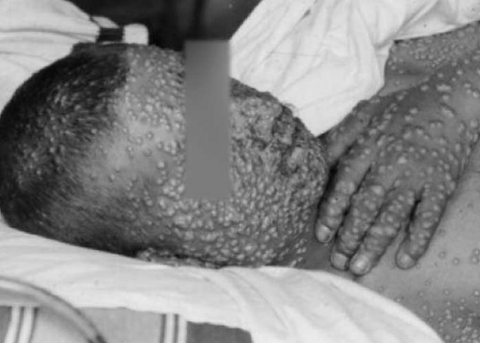 Se confirma en Estados Unidos primer caso de viruela de los monos en 2022.