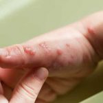 Viruela del mono se expandirá según la OMS