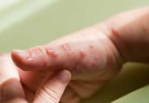 Esto se sabe de la viruela del mono en Perú, España, Israel, Suiza y Alemania Viruela del mono se expandirá según la OMS