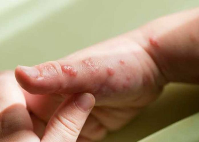 Viruela del mono se expandirá según la OMS