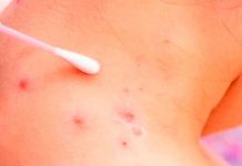 Bolivia activa vigilancia ante brote de viruela de mono