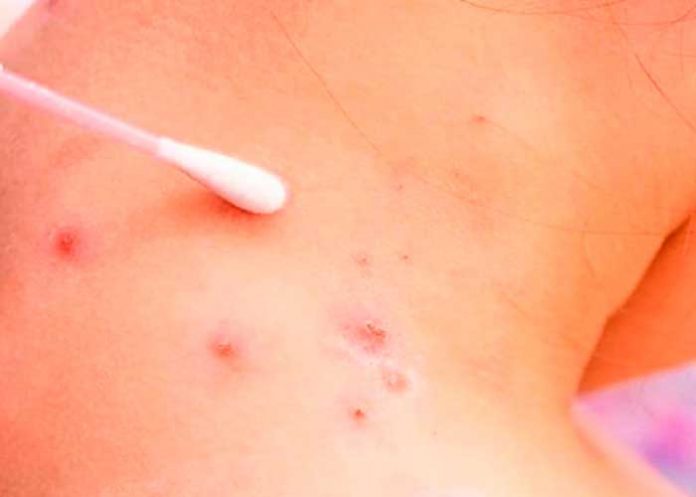 Bolivia activa vigilancia ante brote de viruela de mono