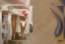 Australia: Sanguijuelas casi arruinan la boda de una mujer