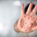 Estados Unidos: Monitorean 6 posibles casos de viruela del mono Estados Unidos: Monitorean 6 posibles casos de viruela del mono