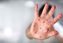 Estados Unidos: Monitorean 6 posibles casos de viruela del mono Estados Unidos: Monitorean 6 posibles casos de viruela del mono