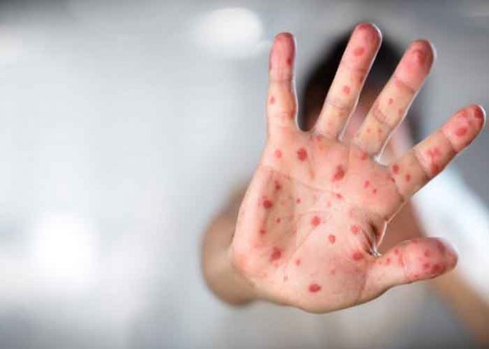 Estados Unidos: Monitorean 6 posibles casos de viruela del mono