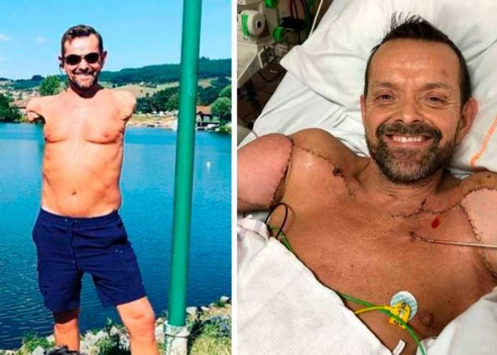 Recibe un trasplante de brazos y al fin puede abrazar a su familia