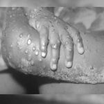 La viruela del mono: Conoce qué es y sus síntomas La viruela del mono: Conoce qué es y sus síntomas