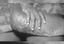 La viruela del mono: Conoce qué es y sus síntomas La viruela del mono: Conoce qué es y sus síntomas