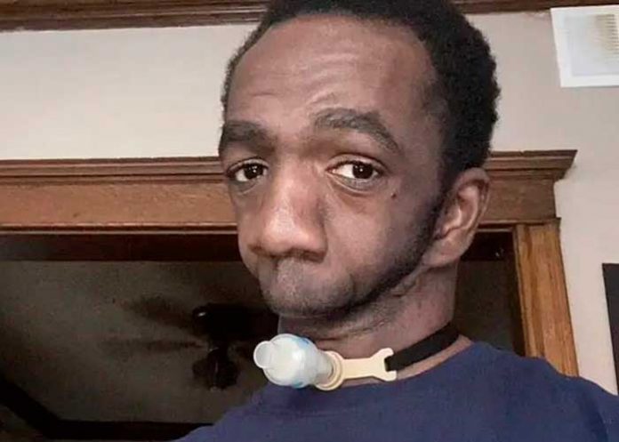 3 Encontró el verdadero amor: Hombre sin mandíbula celebró su boda