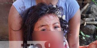 Pitbull ataca a una niña en Chichigalpa, Chinandega