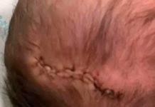 ¡Negligencia! Bebé recibió sutura en cabeza tras caer durante el parto ¡Negligencia! Bebé recibió sutura en cabeza tras caer durante el parto
