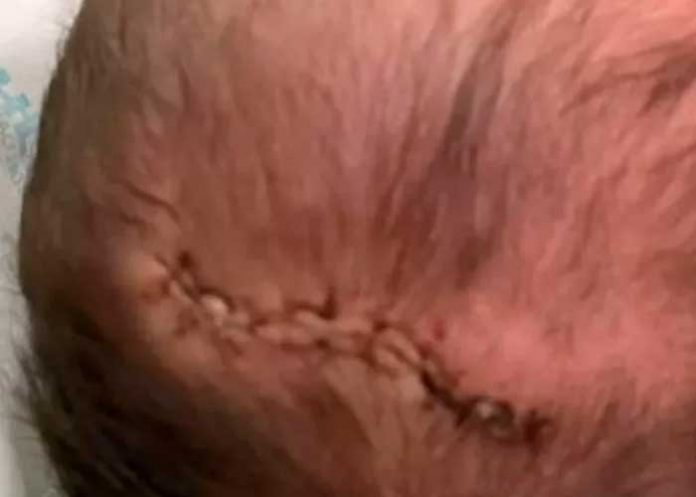 ¡Negligencia! Bebé recibió sutura en cabeza tras caer durante el parto