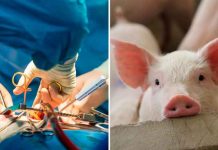 Hombre que recibió corazón de cerdo pudo haber muerto por virus porcino Hombre que recibió corazón de cerdo pudo haber muerto por virus porcino