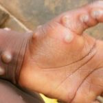 Detectan un caso de viruela del mono en Inglaterra Detectan un caso de viruela del mono en Inglaterra