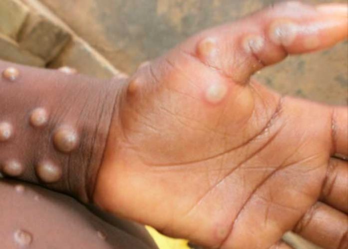 Detectan un caso de viruela del mono en Inglaterra