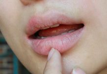 5 enfermedades que puedes detectar por "labios secos"