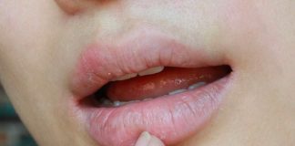 5 enfermedades que puedes detectar por "labios secos"