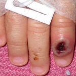 ¡Alerta! México confirma su primer caso de Viruela de Mono