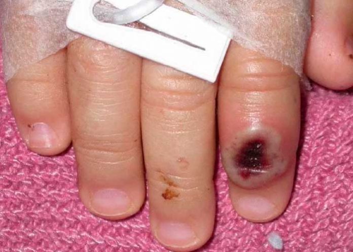 ¡Alerta! México confirma su primer caso de Viruela de Mono