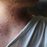 ¡Sin sexo! Personas con síntomas de viruela del mono Personas con viruela abstenerse de relaciones sexuales