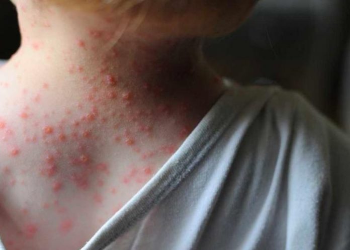 Personas con viruela abstenerse de relaciones sexuales