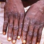 Nigeria confirma un muerto y 21 casos de viruela del mono