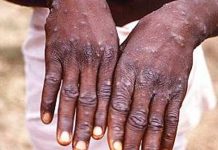 Nigeria confirma un muerto y 21 casos de viruela del mono Nigeria confirma un muerto y 21 casos de viruela del mono