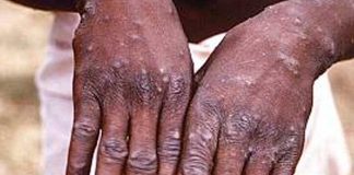 Nigeria confirma un muerto y 21 casos de viruela del mono
