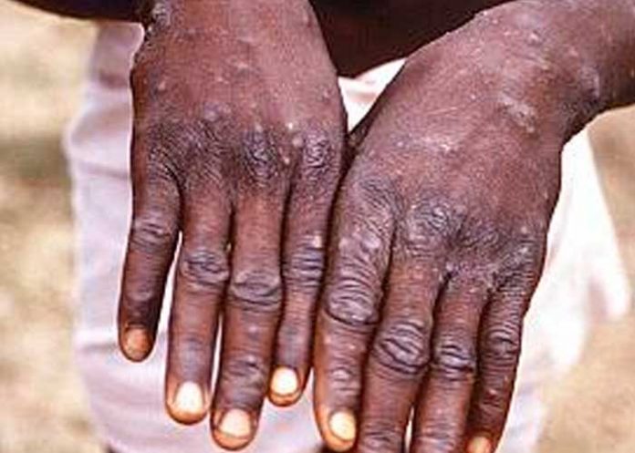 Nigeria confirma un muerto y 21 casos de viruela del mono