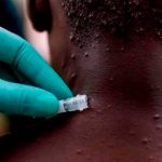 Autoridades sanitarias de Reino Unido investigan 7 casos de viruela de mono