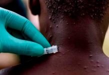 Autoridades sanitarias de Reino Unido investigan 7 casos de viruela de mono