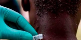 Autoridades sanitarias de Reino Unido investigan 7 casos de viruela de mono