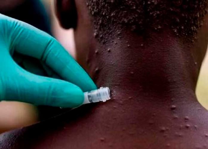 Autoridades sanitarias de Reino Unido investigan 7 casos de viruela de mono