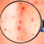 Argentina reporta el primer caso de viruela del mono en América Latina