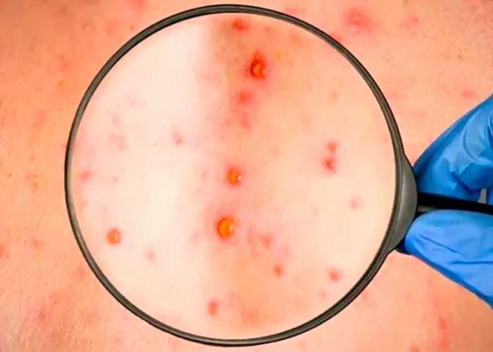 Argentina reporta el primer caso de viruela del mono en América Latina