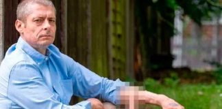 ¡Extraño caso! Hombre pasó 6 años con la "cola" colgando de su brazo